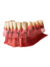 Overdentures - Dentalperiogroup