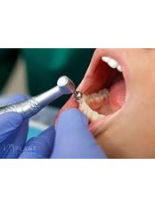 Teeth Cleaning - Nogales Periodental