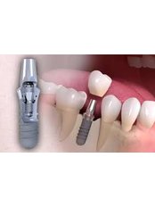Dental Implants - Nogales Periodental