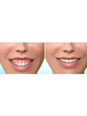 Gum Surgery - Nogales Periodental