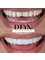 Prime Dental Nogales - Dr Nehemias Mendivil - Bondings - Resin venners by Dr. Mendivil 