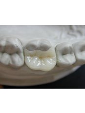 Inlay or Onlay - Dental Sonriza