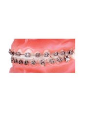Metal Braces - Dental Sonriza
