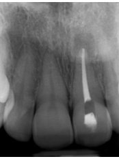 Endodontist Consultation - Dental Sonriza