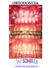 Braces - Dental Sonriza