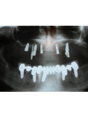 Dental Implants - Alpha Dental Implant Center