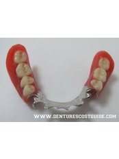 Fixed Partial Dentures - America Dental Clinic