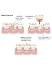 Porcelains Crowns - America Dental Clinic