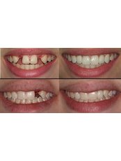 Dental Implants - America Dental Clinic