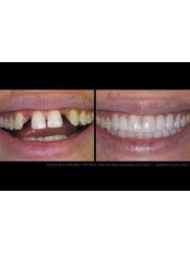 Dental Bridges - America Dental Clinic