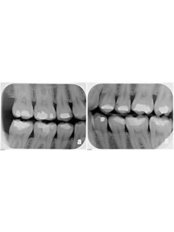 Dental X-Ray - America Dental Clinic