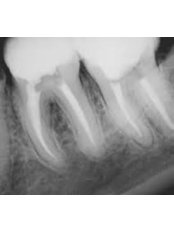 Endodontist Consultation - Aqua Dental