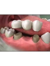 3-Unit Bridge - Aqua Dental