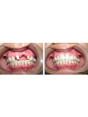 Dental Bridges - Aqua Dental