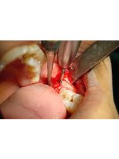 Wisdom Tooth Extraction - CAD/CAM Cosmetic Technology, Dental Artistry Dental Center