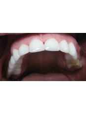 Dental Crowns - CAD/CAM Cosmetic Technology, Dental Artistry Dental Center