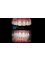 CAD/CAM Cosmetic Technology, Dental Artistry Dental Center - emax veneers cosmetic dentistry 