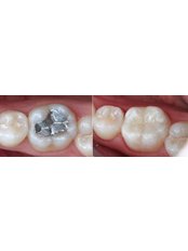 Fillings - CAD/CAM Cosmetic Technology, Dental Artistry Dental Center