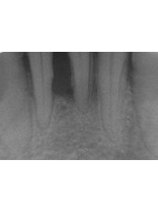 Periodontitis Treatment - CAD/CAM Cosmetic Technology, Dental Artistry Dental Center