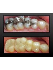 White Filling - CAD/CAM Cosmetic Technology, Dental Artistry Dental Center