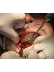Surgical Extractions - CAD/CAM Cosmetic Technology, Dental Artistry Dental Center
