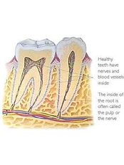 Premolar Root Canal - CAD/CAM Cosmetic Technology, Dental Artistry Dental Center