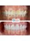 CAD/CAM Cosmetic Technology, Dental Artistry Dental Center - 8 E-Max veneers 