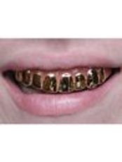 Gold Crown - CAD/CAM Cosmetic Technology, Dental Artistry Dental Center