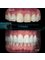 CAD/CAM Cosmetic Technology, Dental Artistry Dental Center - cosmetic e-max veneers 