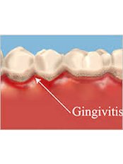 Gingivitis Treatment - DDS Luis Ochoa Hernandez