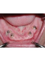 Dental Implants - DDS Luis Ochoa Hernandez