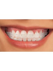 Ceramic Braces - DDS Trejo Dental Clinic ,Doctor Tito