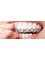 Dental World Dental Centers - DENTAL GUARDS: forget problems of grinding your teeth at night 