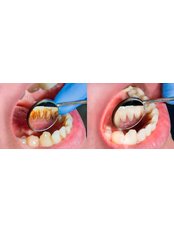 DEEP CLEANINGS - Dental World Dental Centers