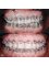 Dental World Dental Centers - Also known as EXPRESS ORTHODONTICS for its very rapid noticeable changes due to its sequence of arches. 