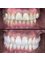 Dental World Dental Centers - We always focus on keeping the tooth intact as much as possible, as was the case in this case, it was rehabilitated with zirconia crowns and dental veneers to adjust everything to the same color, achieving it with our 100% DIGITAL lab. 