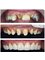 Dental World Dental Centers - REHABILITATION with zirconium crowns 