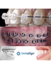 Orthodontics(metal)(sapphire)(self-ligated) - Dental World Dental Centers