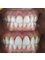 Dental World Dental Centers - GINGIVAL RECONTOURING: a practical and noble way with soft tissues (gum) to discover and give a contour as perfect as possible (no bleeding problems) (no post-operative pain) (instant results) 