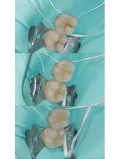 DENTAL FILLINGS - Dental World Dental Centers