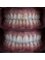 Dental World Dental Centers - MINIMAL INVASION dental veneers 