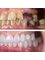 Dental World Dental Centers - rehabilitation of implants adjusting the color tone equal to the rest of the crowns on natural teeth 