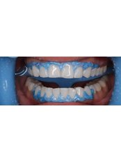Teeth Whitening - Dental World Dental Centers