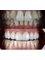 Dental World Dental Centers - Dental Veneres 