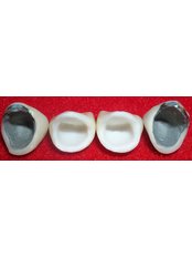 Dental Crowns - Dr. Alejandro Benitez Dental Clinic