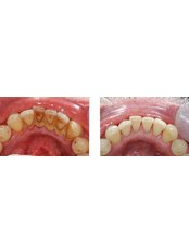 Scaling and Root Planing - Dr. Alejandro Benitez Dental Clinic