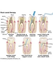 Root canals - Dr. Alejandro Benitez Dental Clinic