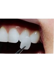 Veneers - Dr. Alejandro Benitez Dental Clinic