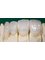 Dr Chio Dental Clinic - Individual zirconia crowns (metal free) 