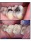 Dr Chio Dental Clinic - Before and after White Filling  